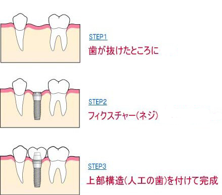 インプラント解説