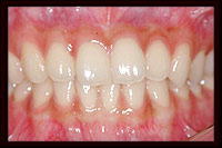 ホワイトニング